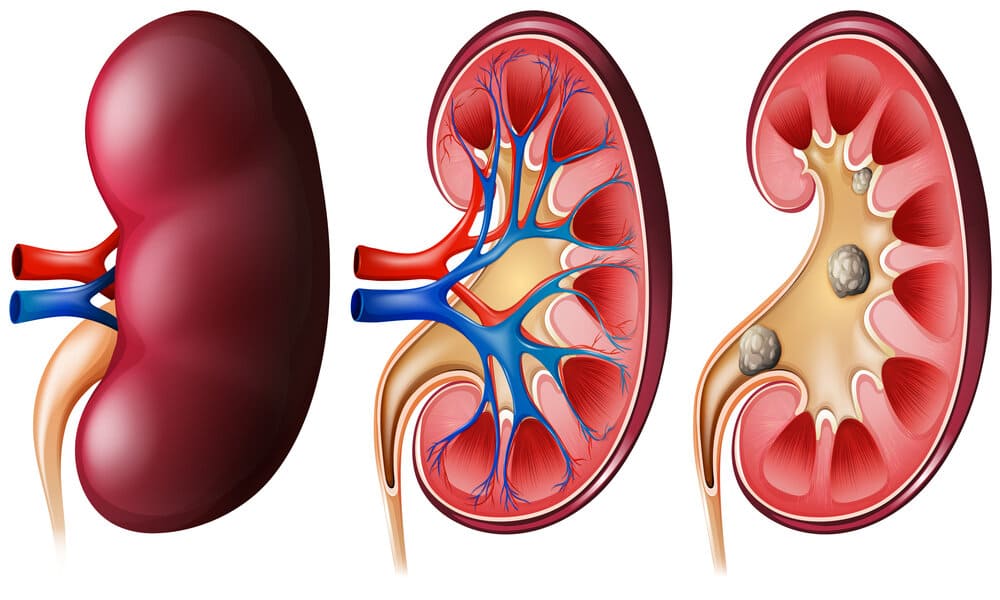 Litiasis renal